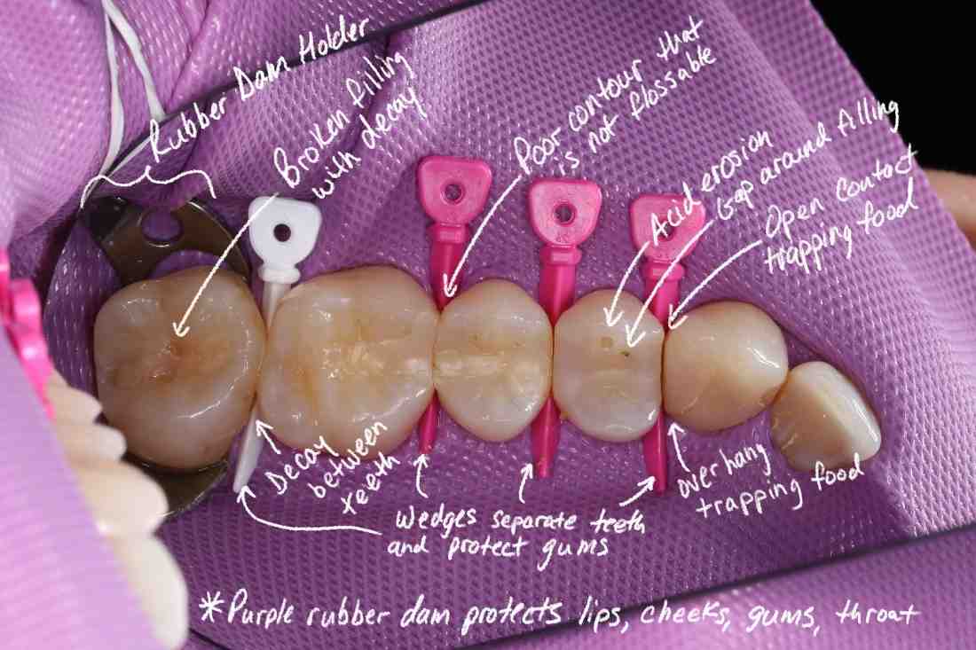 Does food get stuck in dental implants?