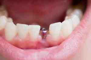 Does insurance cover mini dental implants?