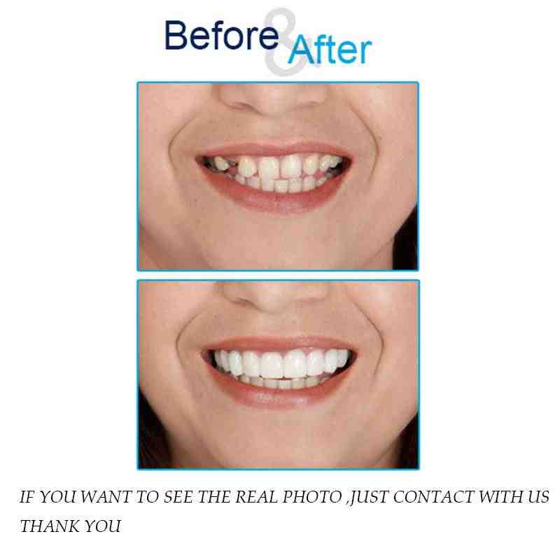 Does snap on smile really work?