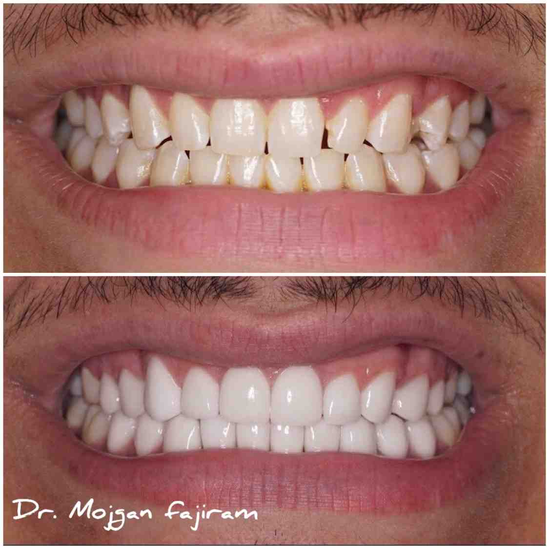 How Much Does a full dental makeover cost?