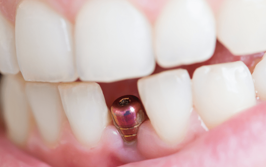 How Safe Are Mini dental implants?