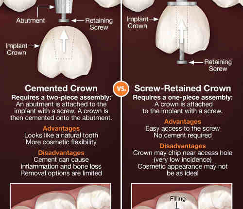 How are abutments attached to dental implants?