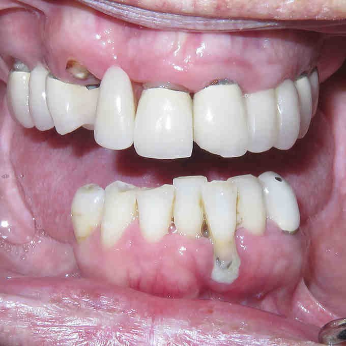 How can I get dental implants covered by insurance?