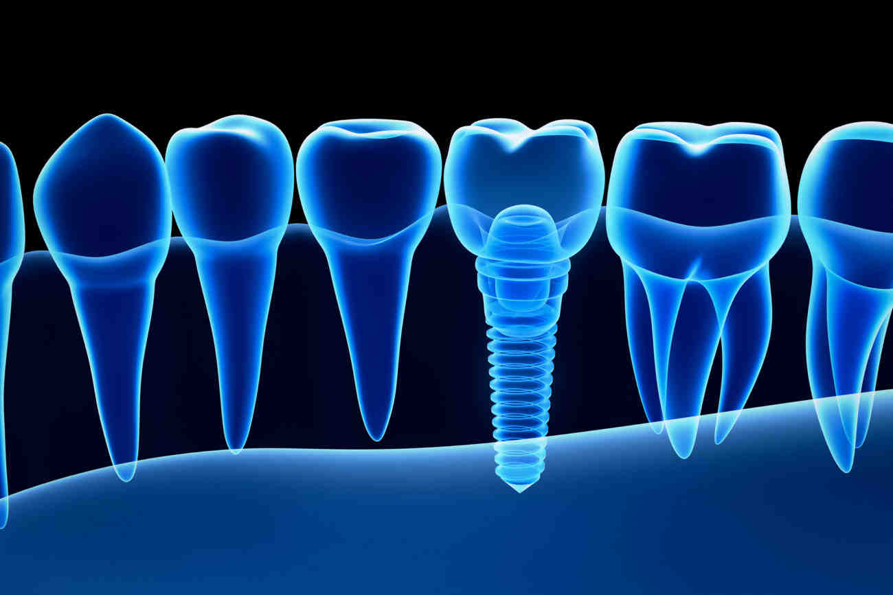 How can I protect my dental implants?