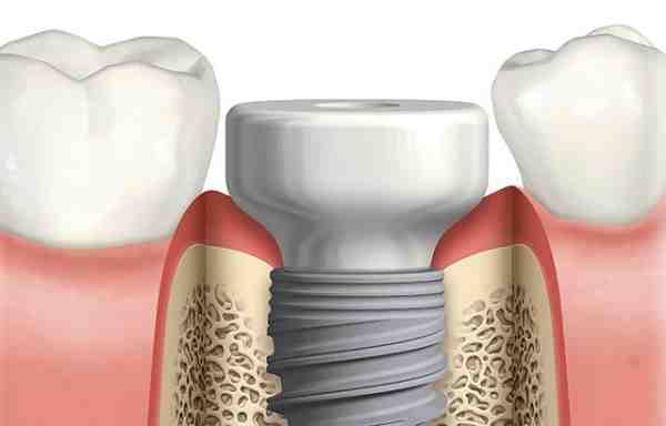How can I speed up bone graft healing?
