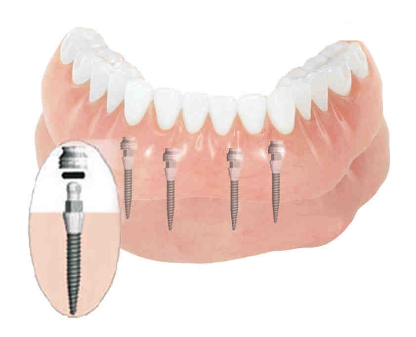 How do I know what type of dental implant I have?