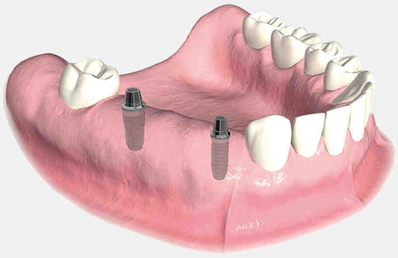How do poor people afford dental implants?