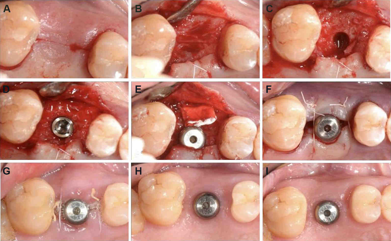 How do you clean gums after an implant?