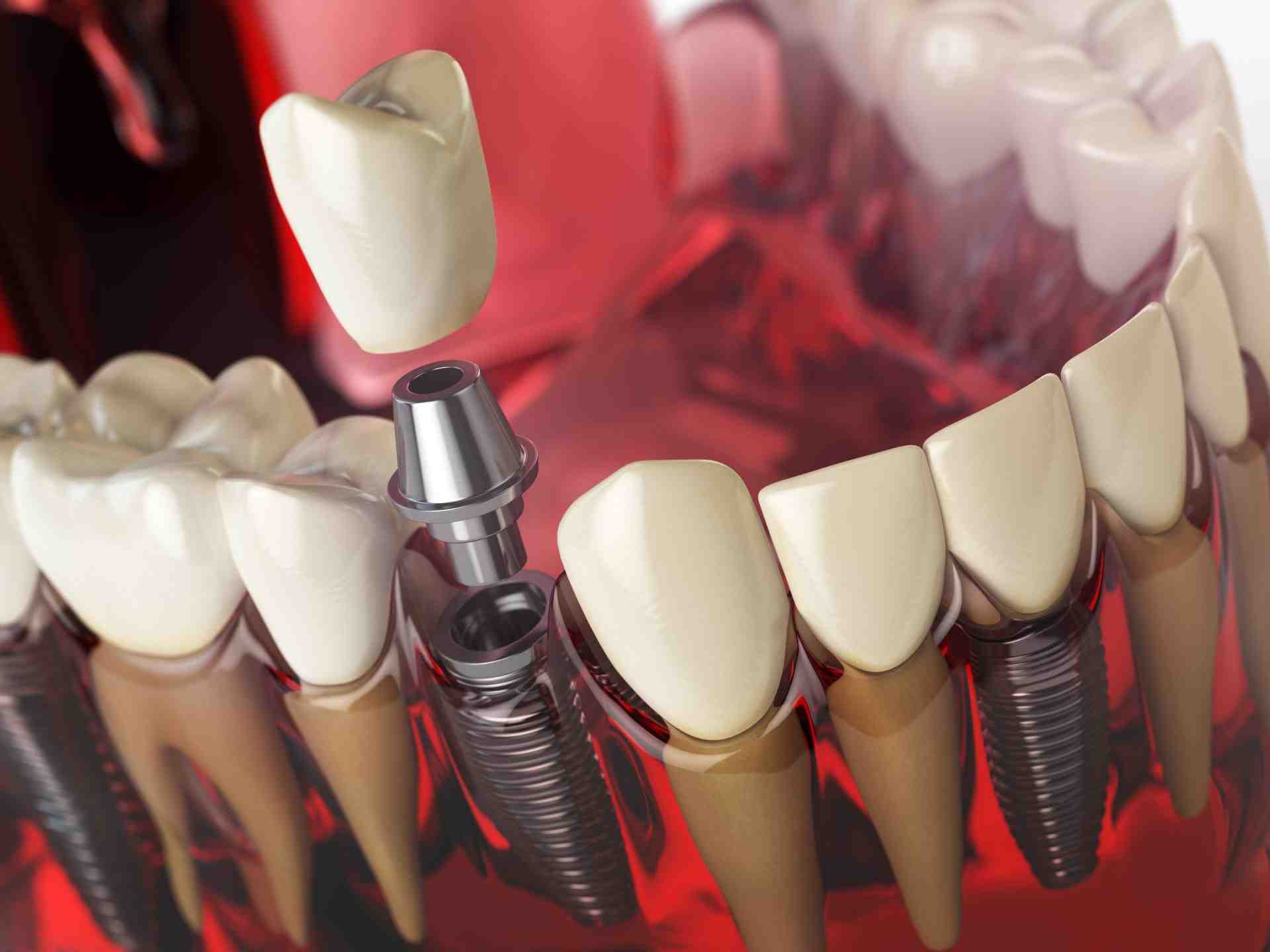 How do you pay for dental implants?