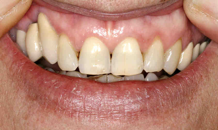 What happens if dental implant bone graft fails Dental News Network