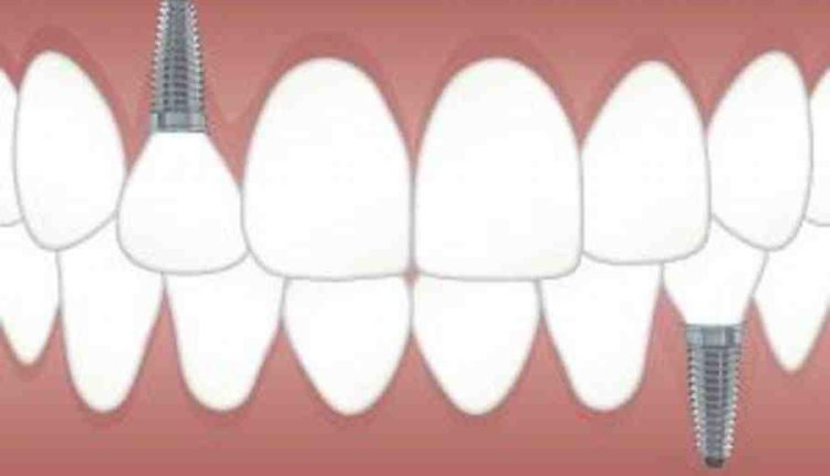 How dose dental implants