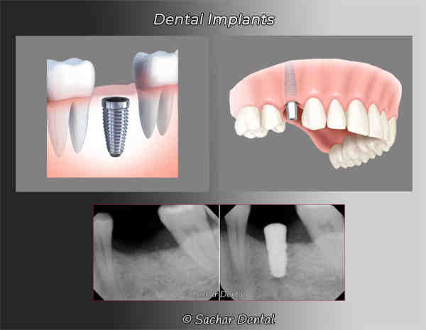 How is implant attached to abutment?