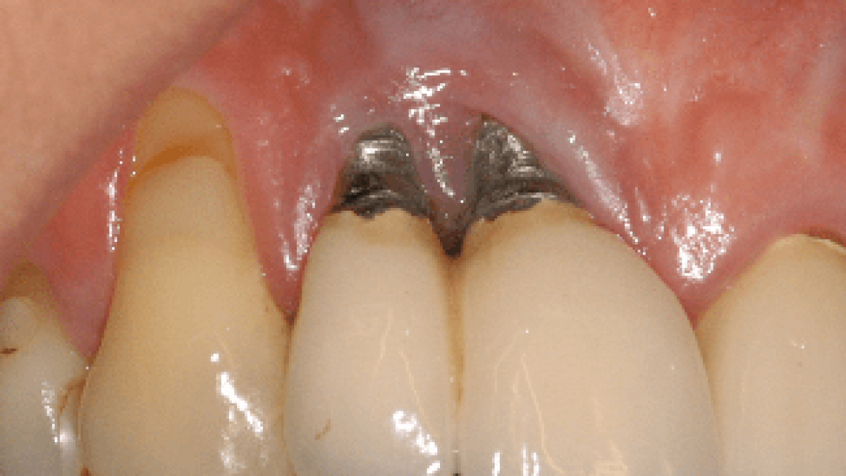 What Happens If Dental Implant Bone Graft Fails Dental News Network