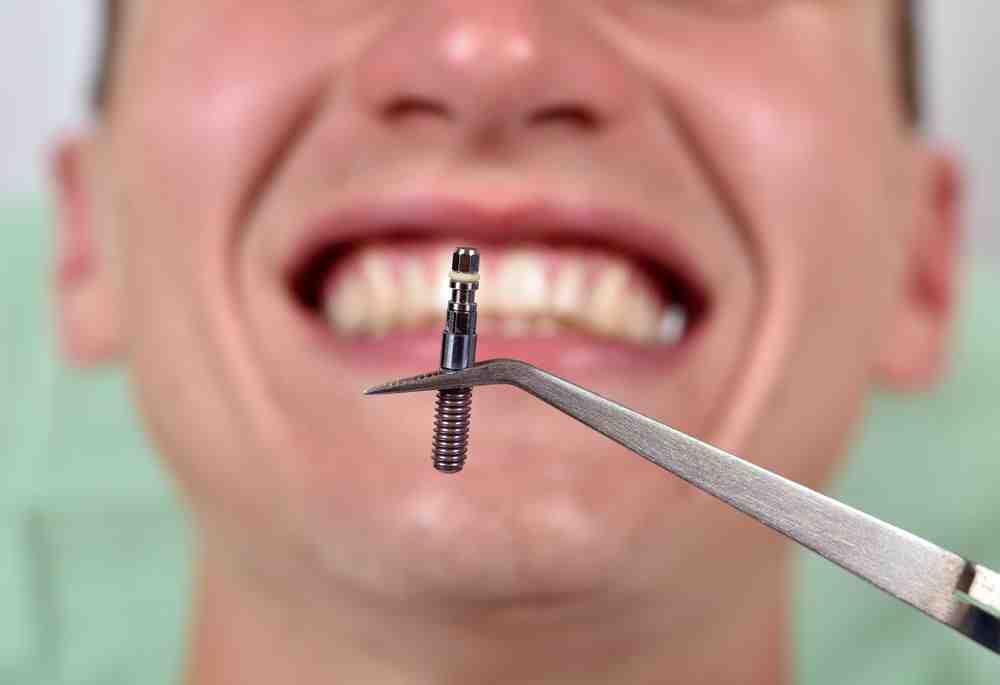 how-long-does-it-take-for-a-dental-implant-to-heal-dental-news-network