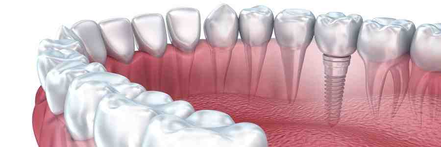 How long before dental implants stop hurting?