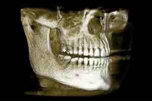 How long can you wait between dental implant and crown?