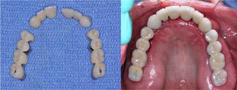 How long can you wait to put a crown on an implant?