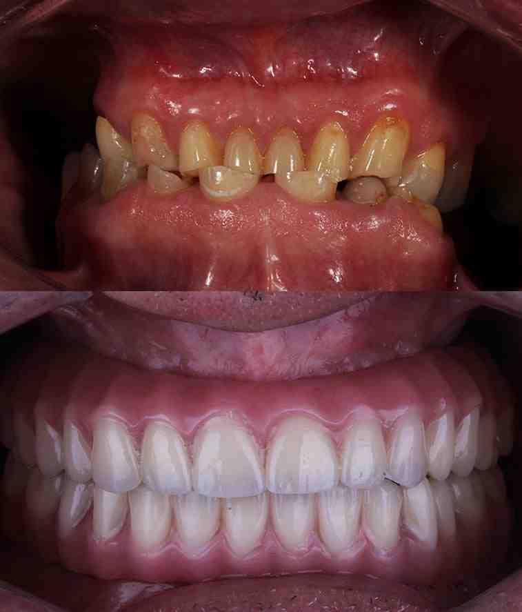 How long do ceramic implants last?