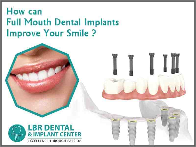 How long do full mouth dental implants last?