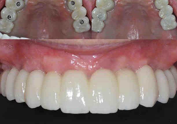 How long do it take to get dental implants