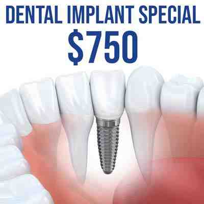 How long does dental implant last after it expires?