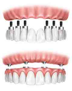 How long does it take for dental implants to settle?