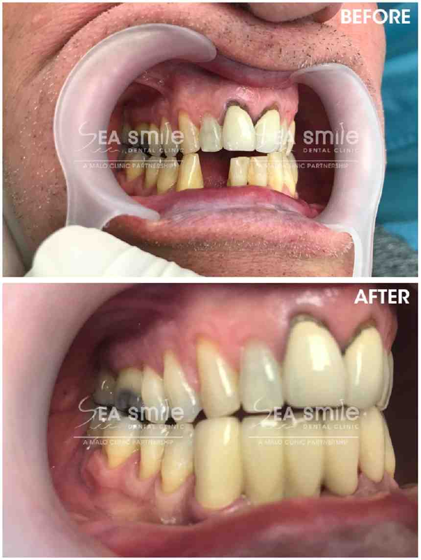 How long does it take for dental implants to settle?