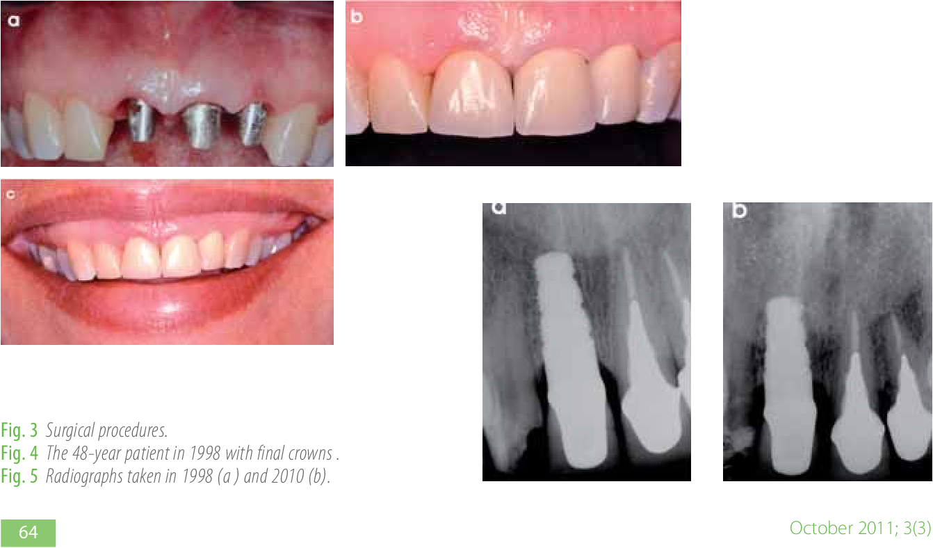 How long does it take for dental implants to settle?