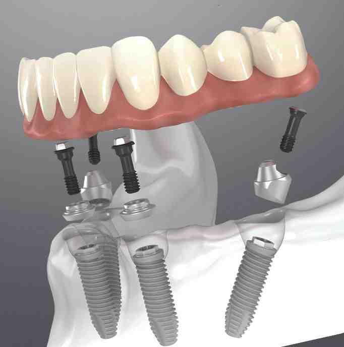 How long does it take for gums to heal after dental implants?
