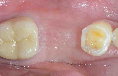 How long does it take to get used to dental implants?