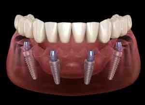 How long does it take to replace all teeth with implants?