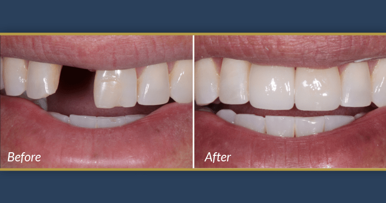 How long is a dental implant supposed to hurt?
