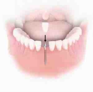 How long will mini implants last?