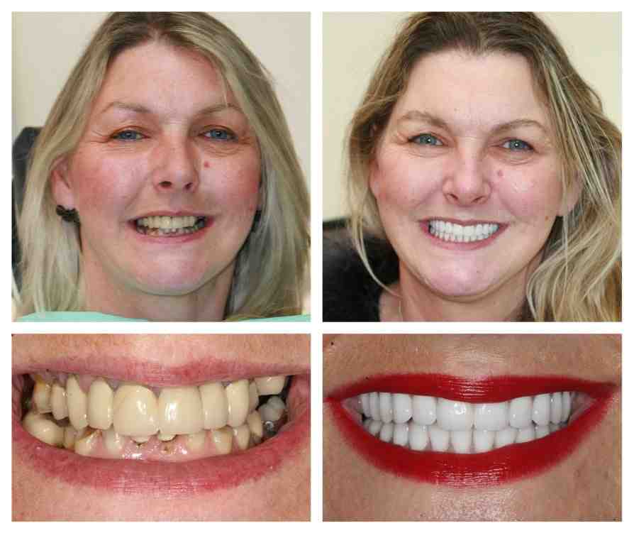Who makes dental implants Dental News Network