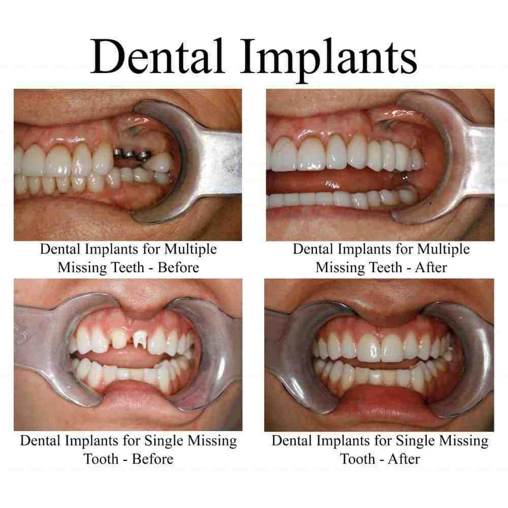 How much are dental implants for the whole mouth in Mexico?