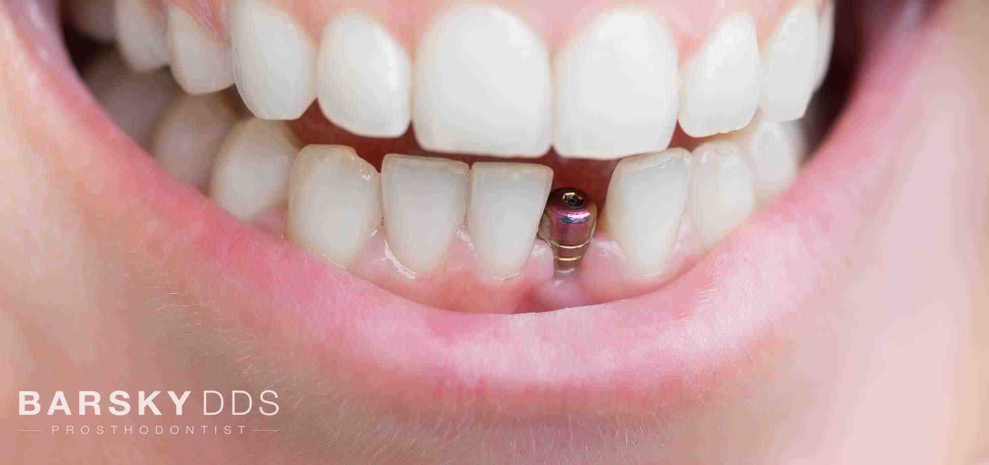 How much are dental implants just for the top?