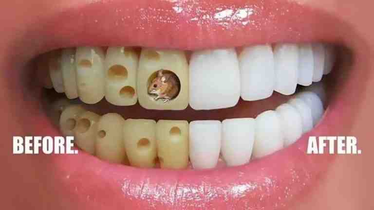 How much do celebrities pay for veneers?