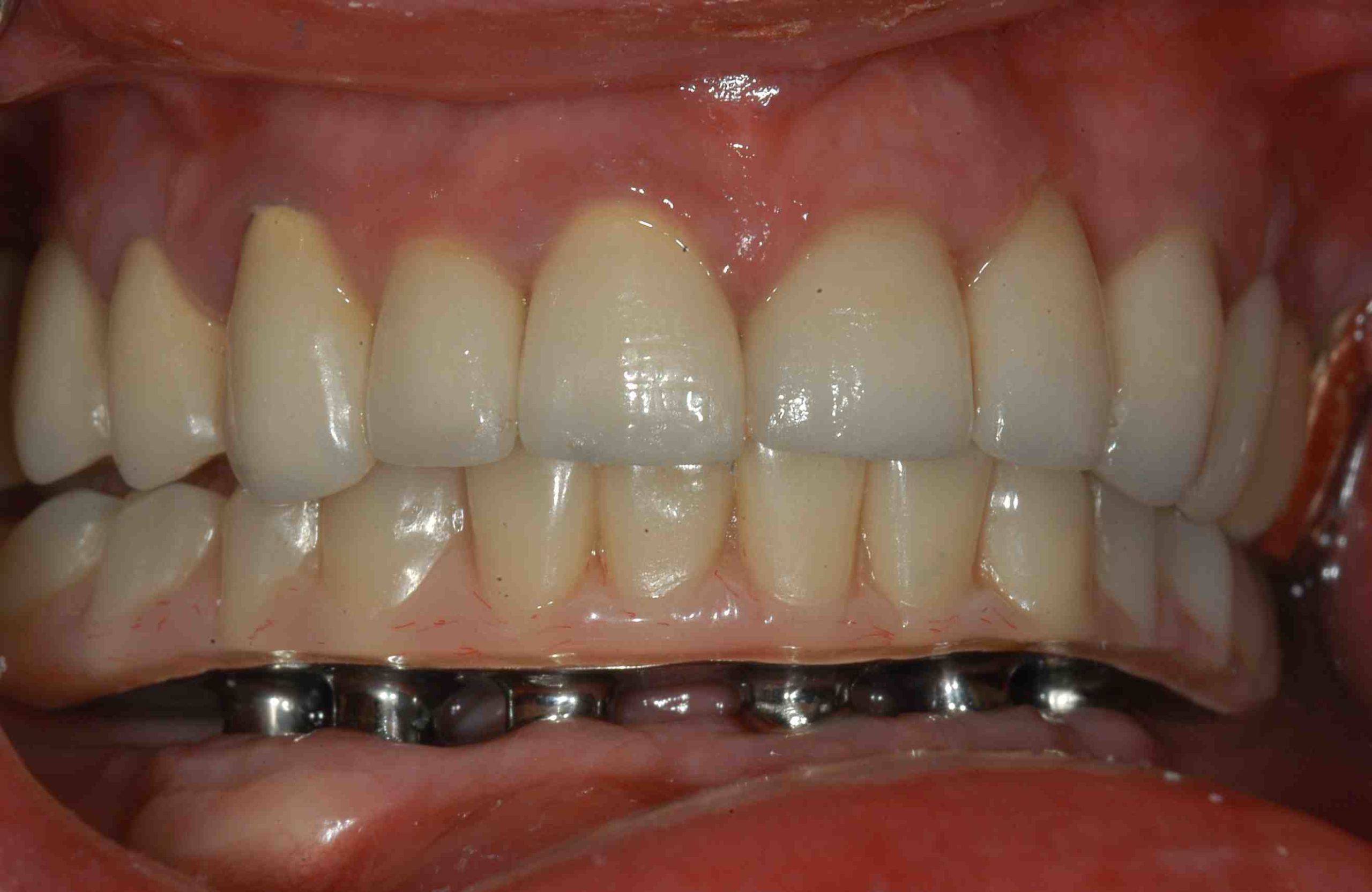 What is hybrid dental implants Dental News Network