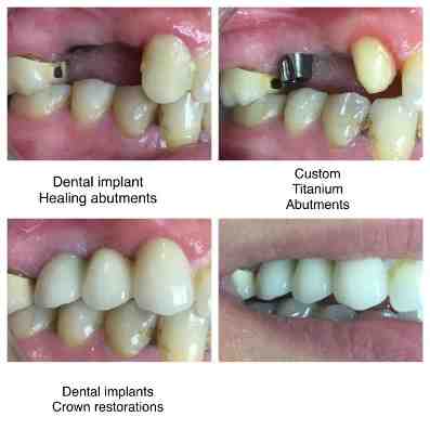 How much do implant crowns cost?