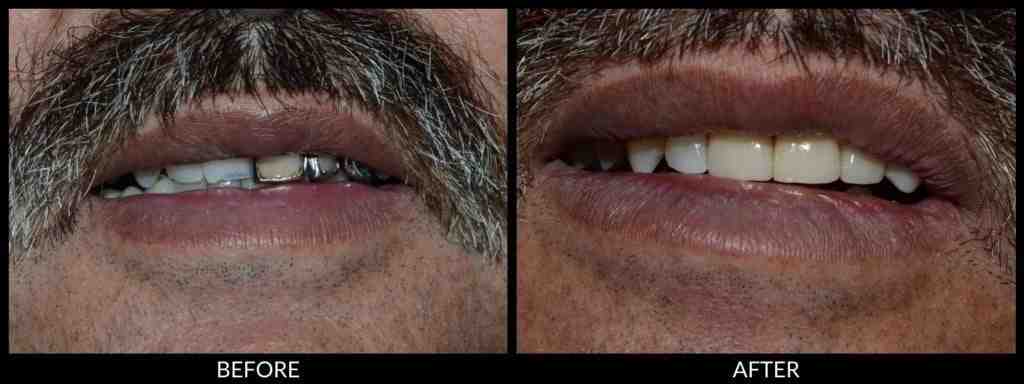 How much do veneers cost in DC?
