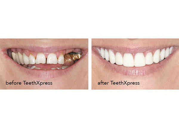 How much do you have to put down for dental implants