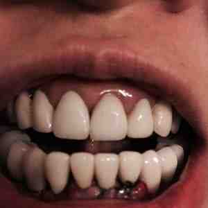 How much does ClearChoice charge for dental implants?