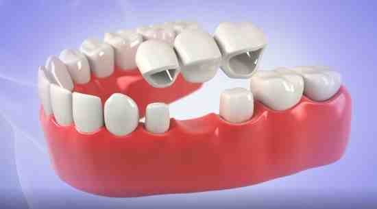 How much does a bridge implant cost?