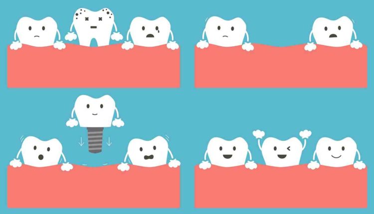 How much does a clear choice dental implant cost in new york
