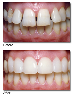 How much does a cosmetic tooth filling cost?