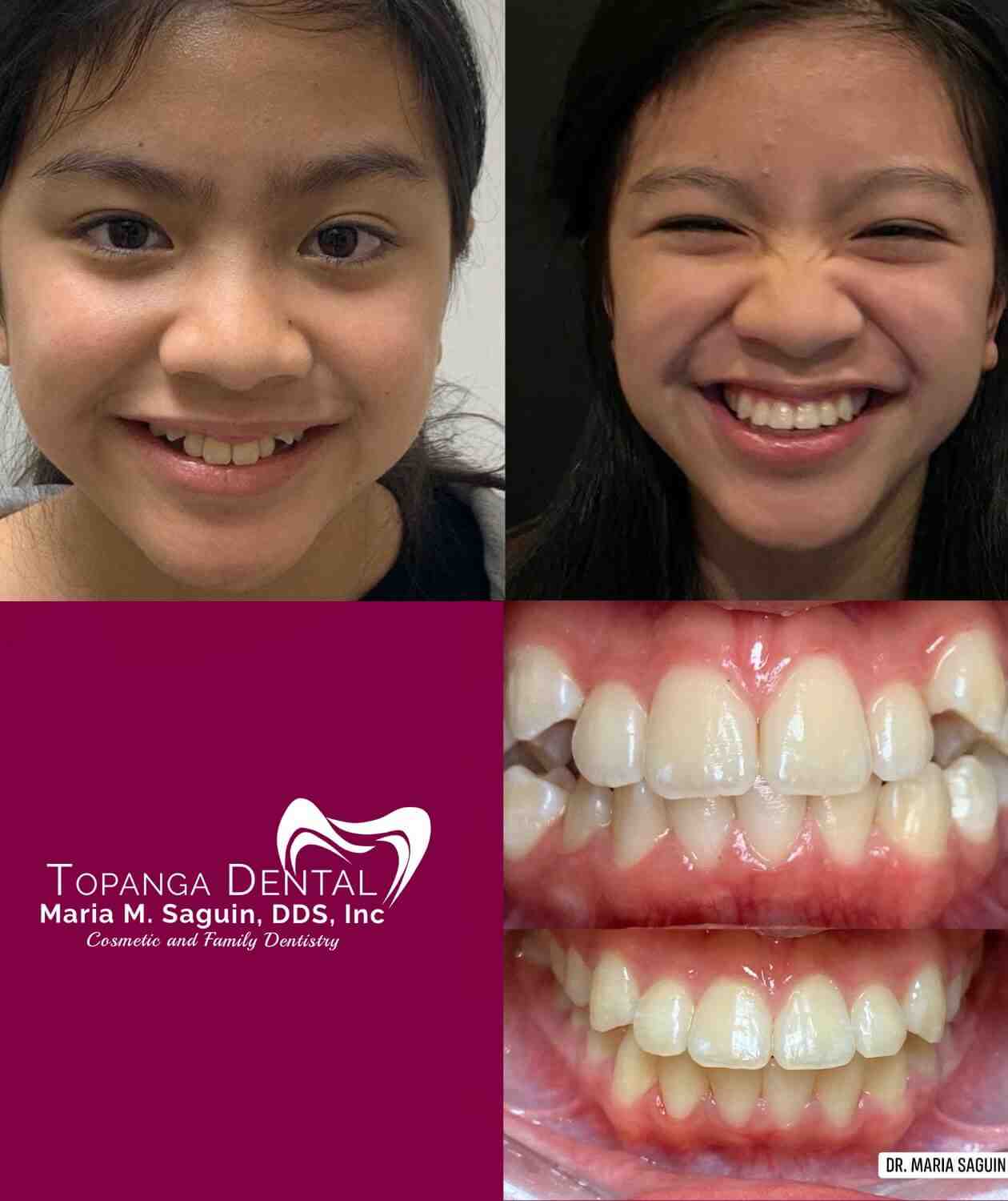 How much does a cosmetic tooth filling cost?