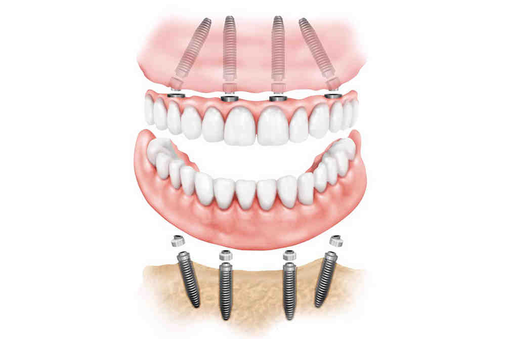 How much does a dental implant cost for one tooth?