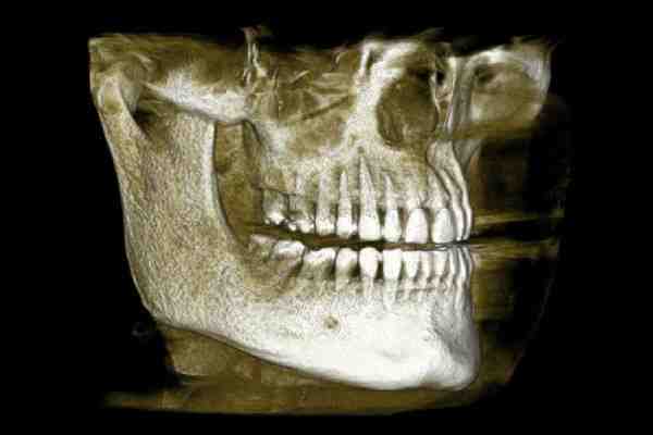 How much does a dental implant cost for one tooth?