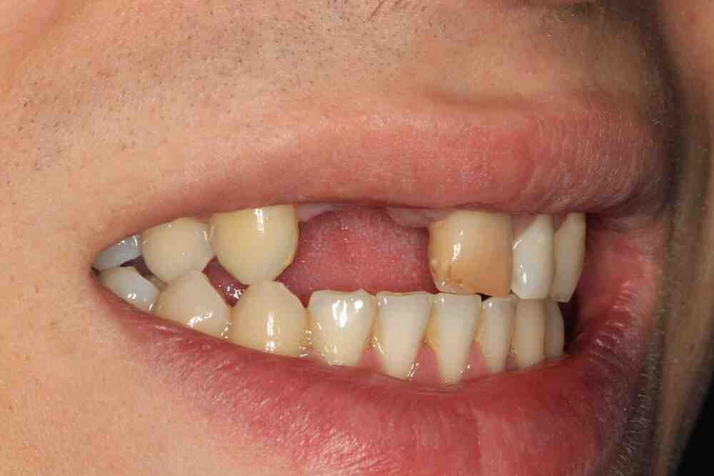 How much does a dental implant cost for one tooth?