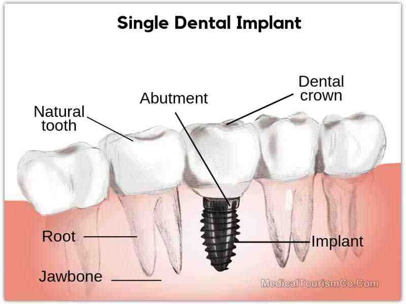 How much does a dental implant cost out of pocket?
